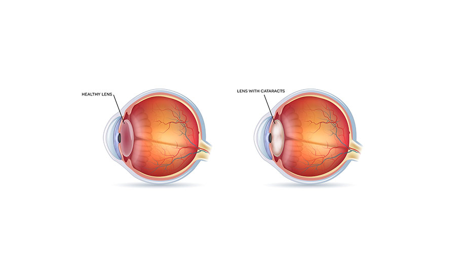 cataract surgery graphic